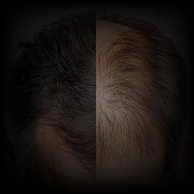 injerto-capilar-03 injerto-capilar-03