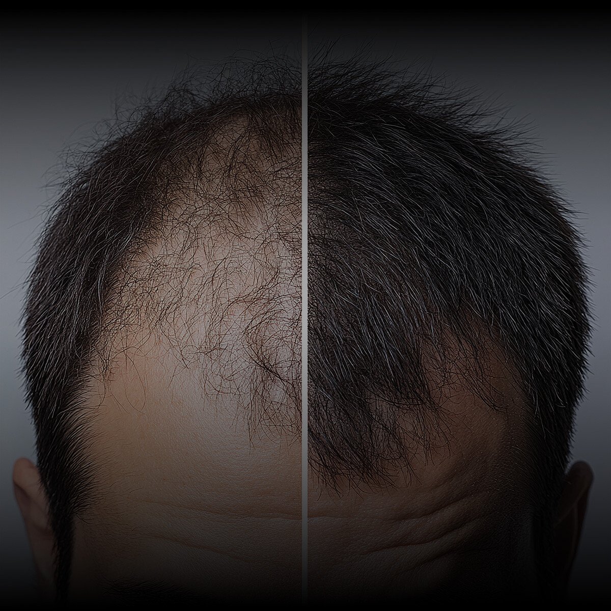 injerto-capilar-comparativo-1 injerto-capilar-comparativo-1